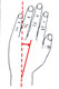 Handgelenk radial